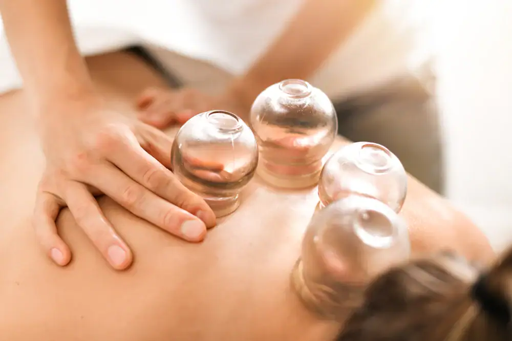 A person receives cupping therapy on their back with four glass cups placed on the skin, while a practitioner’s hand gently presses on the back—an approach sometimes integrated with physical therapy in Suffolk & Nassau County.
